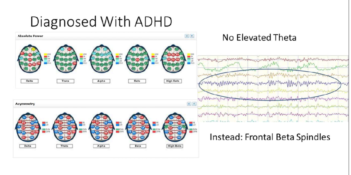 No Elevated Theta in ADHD Cases